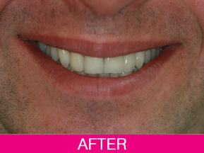 dental implant after
