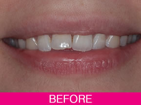 smile makeoverbefore