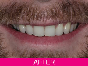 tooth whitening after